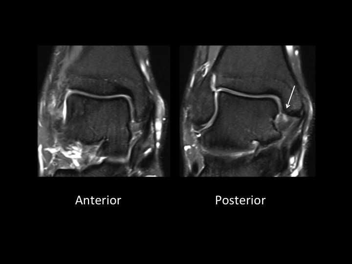 Figure 4 for case anteromedial ankle impingement